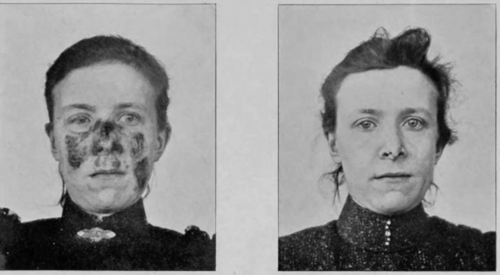 En kvinde før og efter behandling med Niels R. Finsens lysterapi.